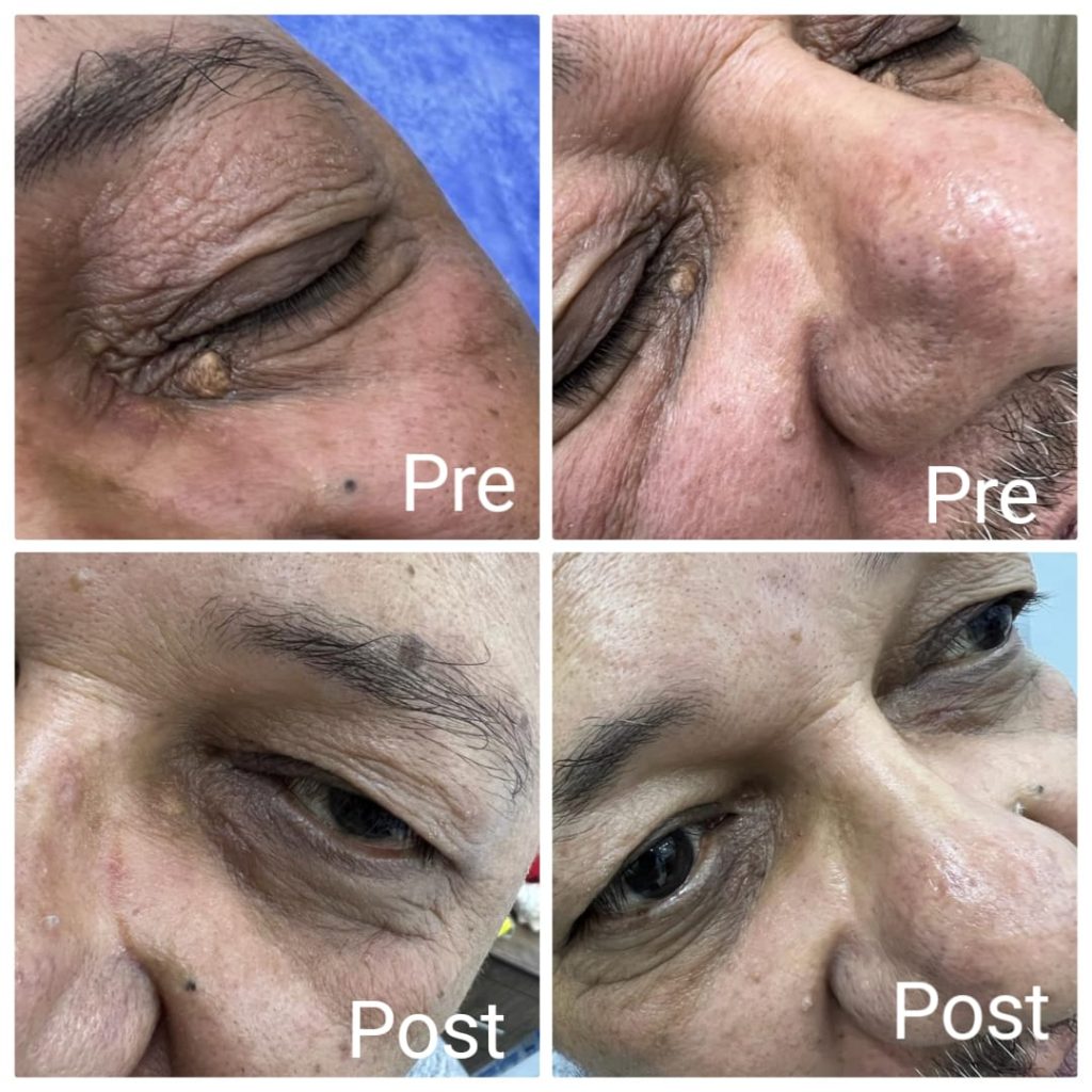 ازالة دهون الكولسترول حول العين